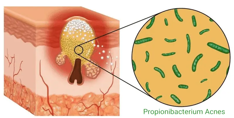 propionibacterium-acnes