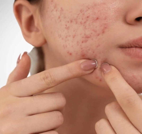 Dermatolog Florentina Zaharia:  Îngrijirea pielii și tratarea acneei la adolescente
