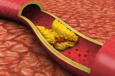 Dislipidemia la copii: simptome, diagnostic, tratament