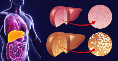 Tratamentul steatozei hepatice la copii