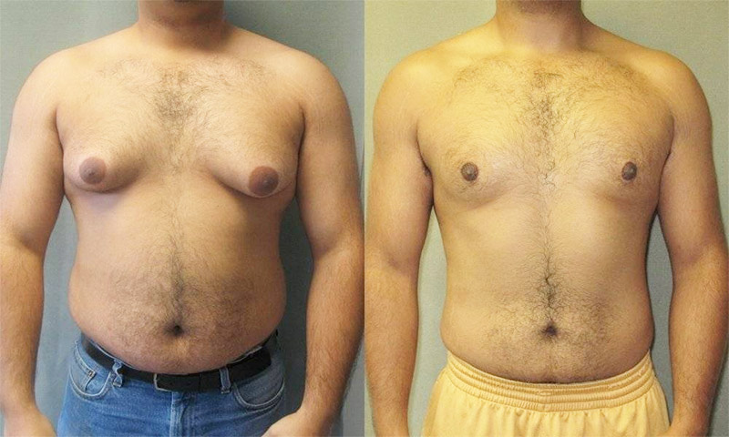 ginecomastia-2