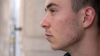 Cum abordăm acneea în adolescență