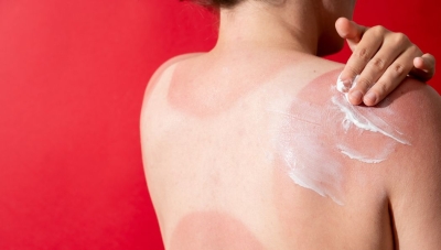 Pas cu pas de la specialist: ce să faci când copilul are arsuri solare